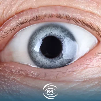 الجلوكوما الثانوية في العين (مضاعفاتها وانواعها ) 